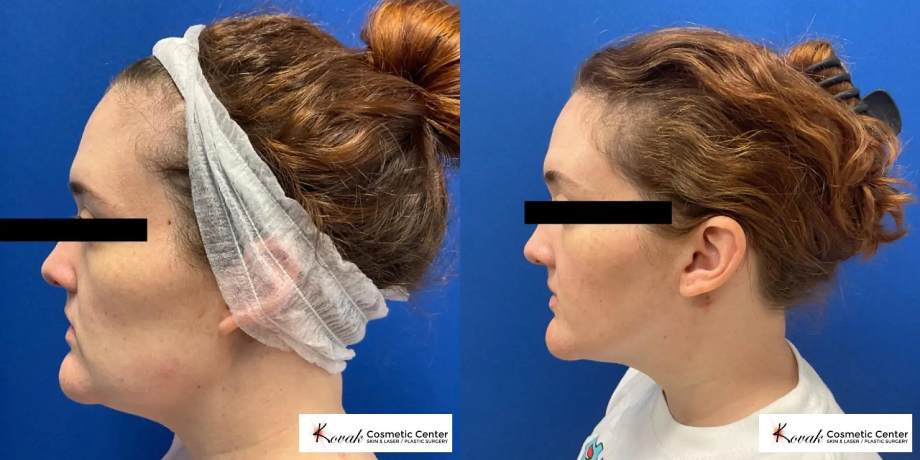 VLR - Vaser Laser - Jawline Sculpting: Patient 14 - Before and After 1