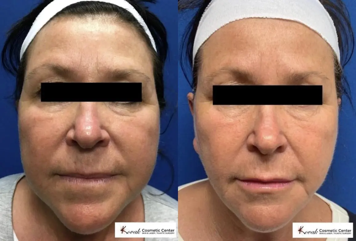 VLR - Vaser Laser - Jawline Sculpting: Patient 4 - Before and After 2