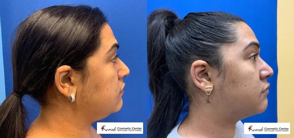 VLR - Vaser Laser - Jawline Sculpting: Patient 11 - Before and After 1