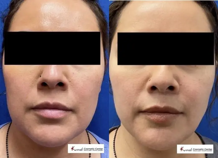 VLR - Vaser Laser - Jawline Sculpting: Patient 5 - Before and After 3