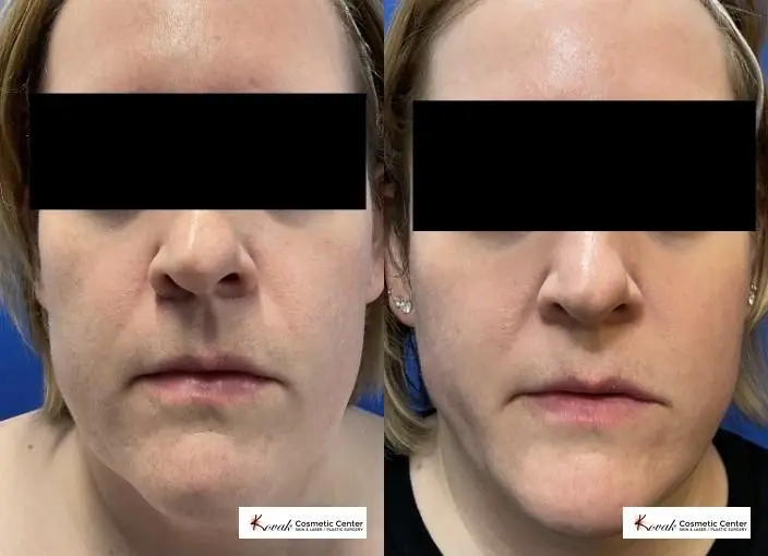 VLR - Vaser Laser - Jawline Sculpting: Patient 7 - Before and After  