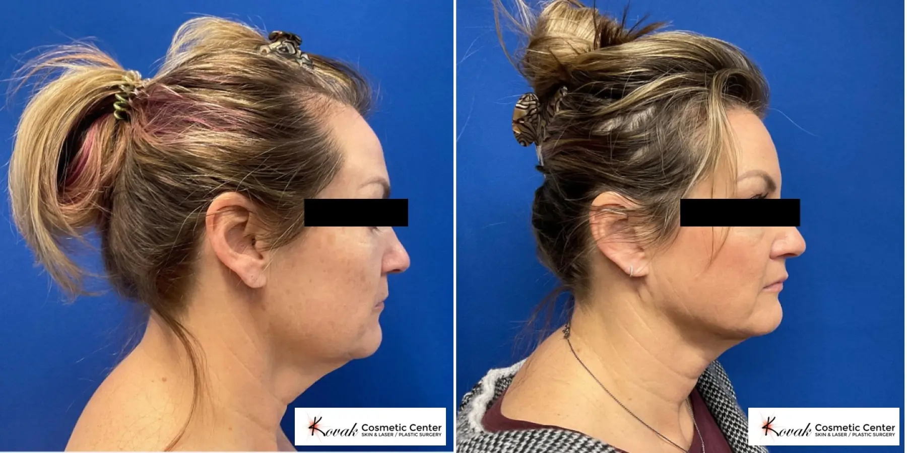 VLR - Vaser Laser - Jawline Sculpting: Patient 15 - Before and After 1