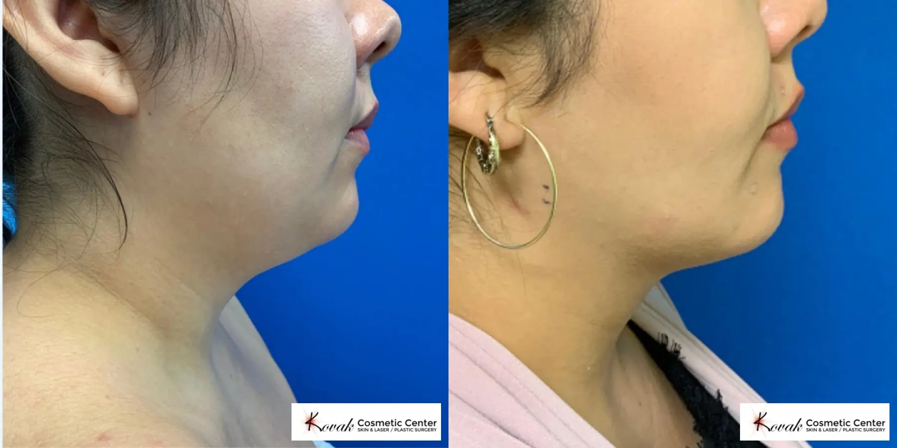VLR - Vaser Laser - Jawline Sculpting: Patient 12 - Before and After 2