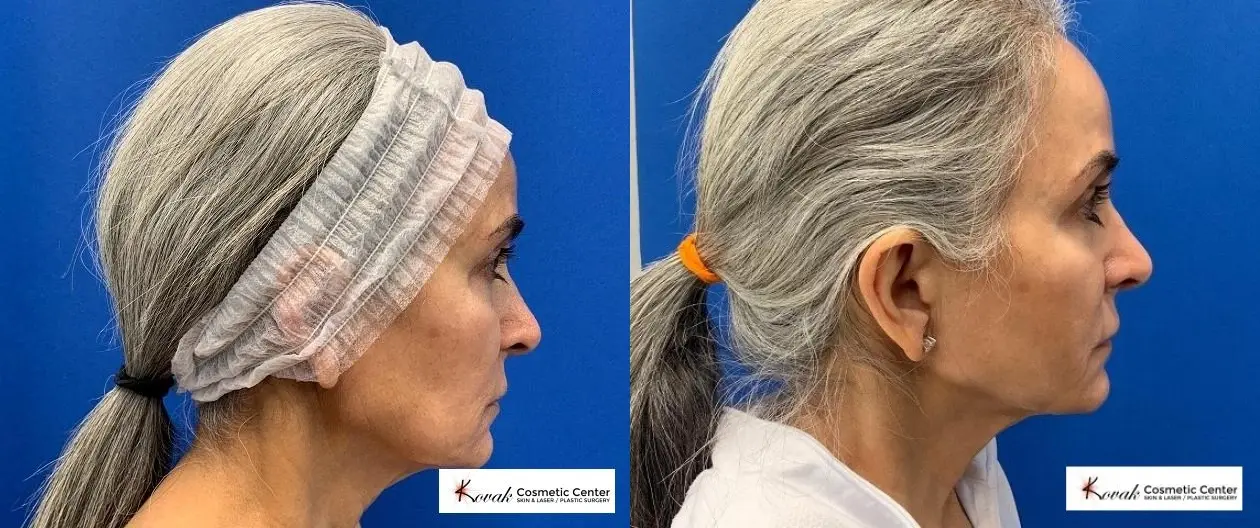 VLR - Vaser Laser - Jawline Sculpting: Patient 10 - Before and After  