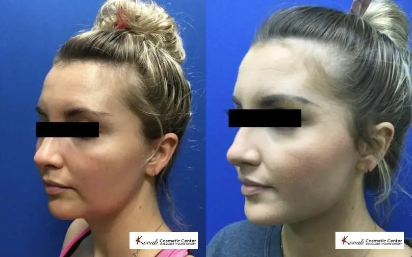 VLR - Vaser Laser - Jawline Sculpting: Patient 1 - Before and After  