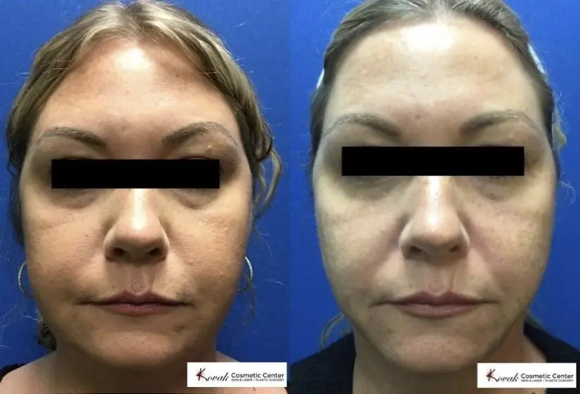 VLR - Vaser Laser - Jawline Sculpting: Patient 9 - Before and After  