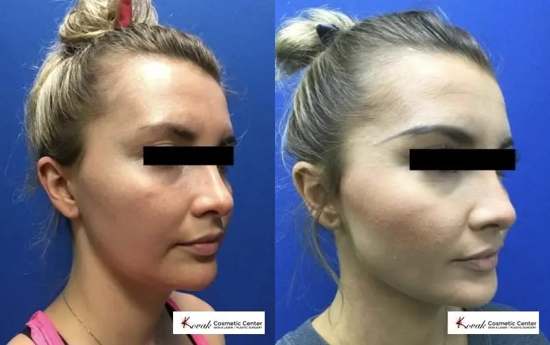 VLR - Vaser Laser - Jawline Sculpting: Patient 1 - Before and After 2
