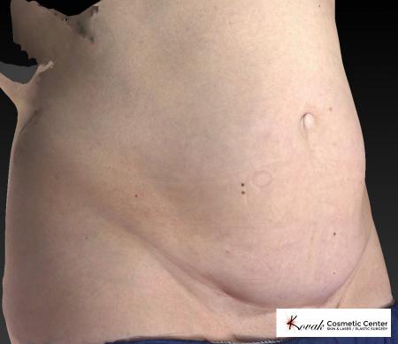 CoolSculpting®: Patient 12 - Before 2