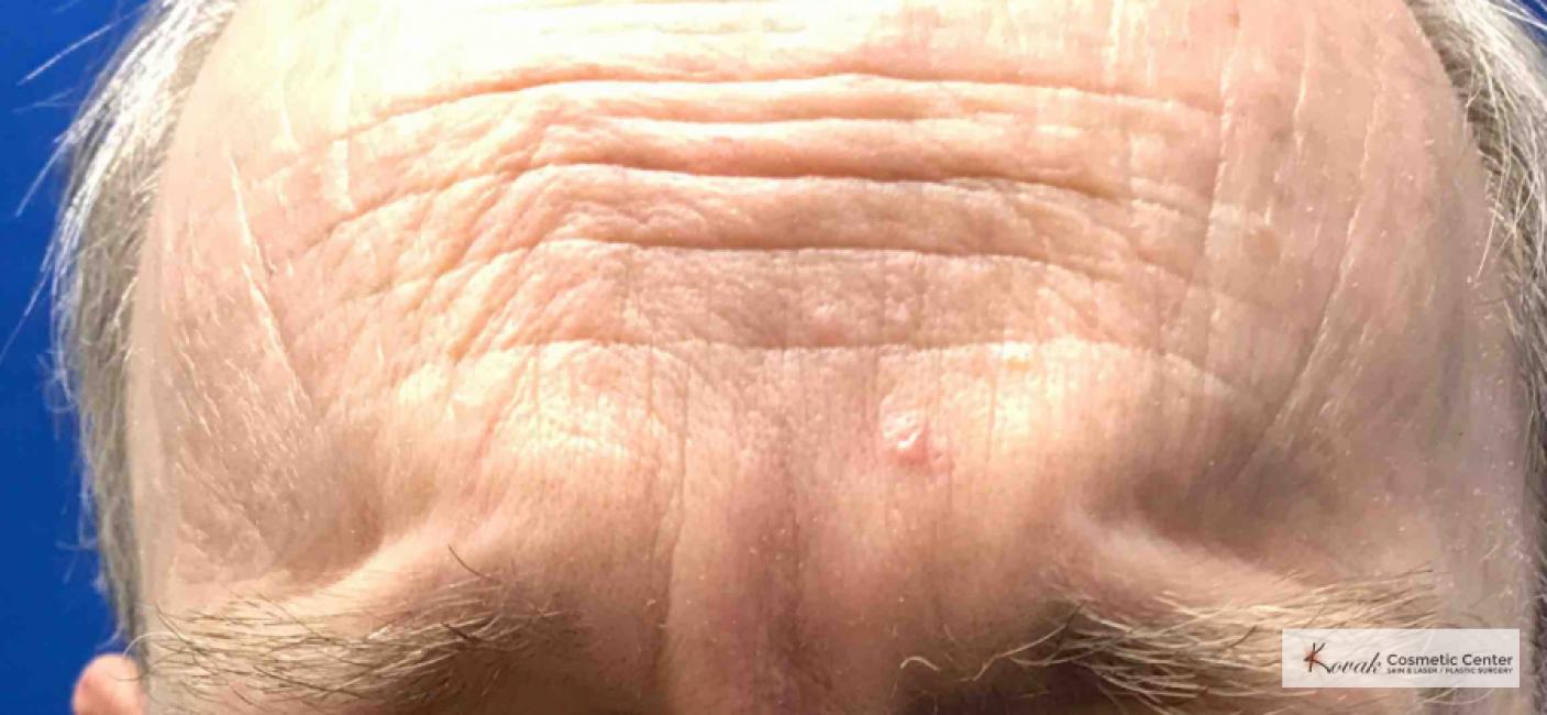 Juvéderm® XC: Patient 10 - After  