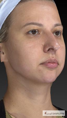 Restylane® Lyft: Patient 1 - After 5