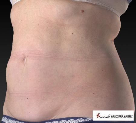 CoolSculpting®: Patient 12 - After 3