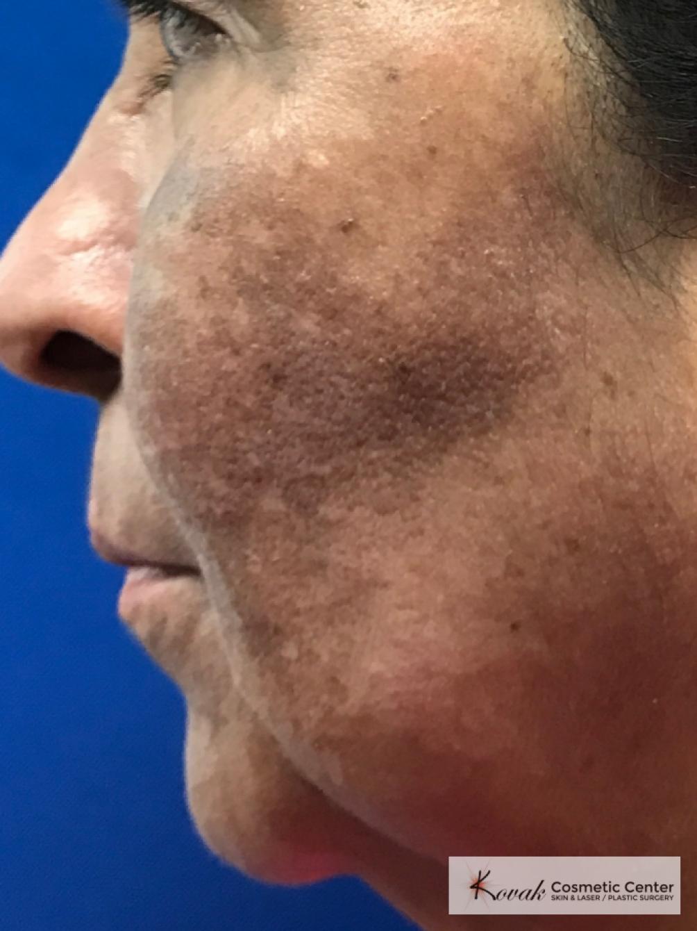 Melasma treatment using Venus Viva on a 57 year old female - Before 