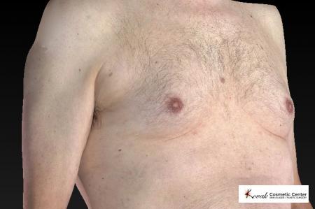 CoolSculpting®: Patient 7 - Before and After 3
