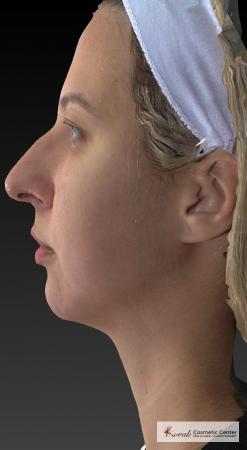 Restylane® Lyft: Patient 1 - After 2