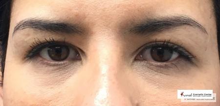 Restylane® Silk: Patient 1 - After  