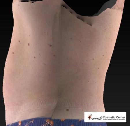 CoolSculpting®: Patient 19 - After 2