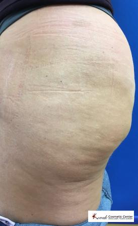 Cellulite Reduction: Patient 4 - After 2