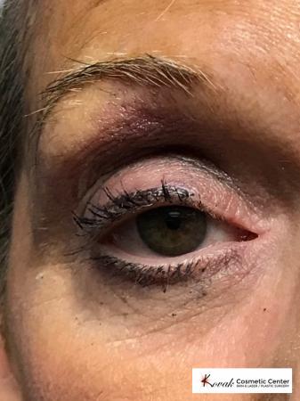 Modified Botox Brow Raise on a 64 year old Woman - Before and After 2