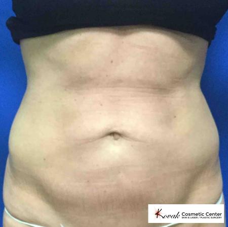 EMSCULPT®: Patient 2 - Before 1