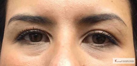 Restylane® Silk: Patient 14 - Before 1