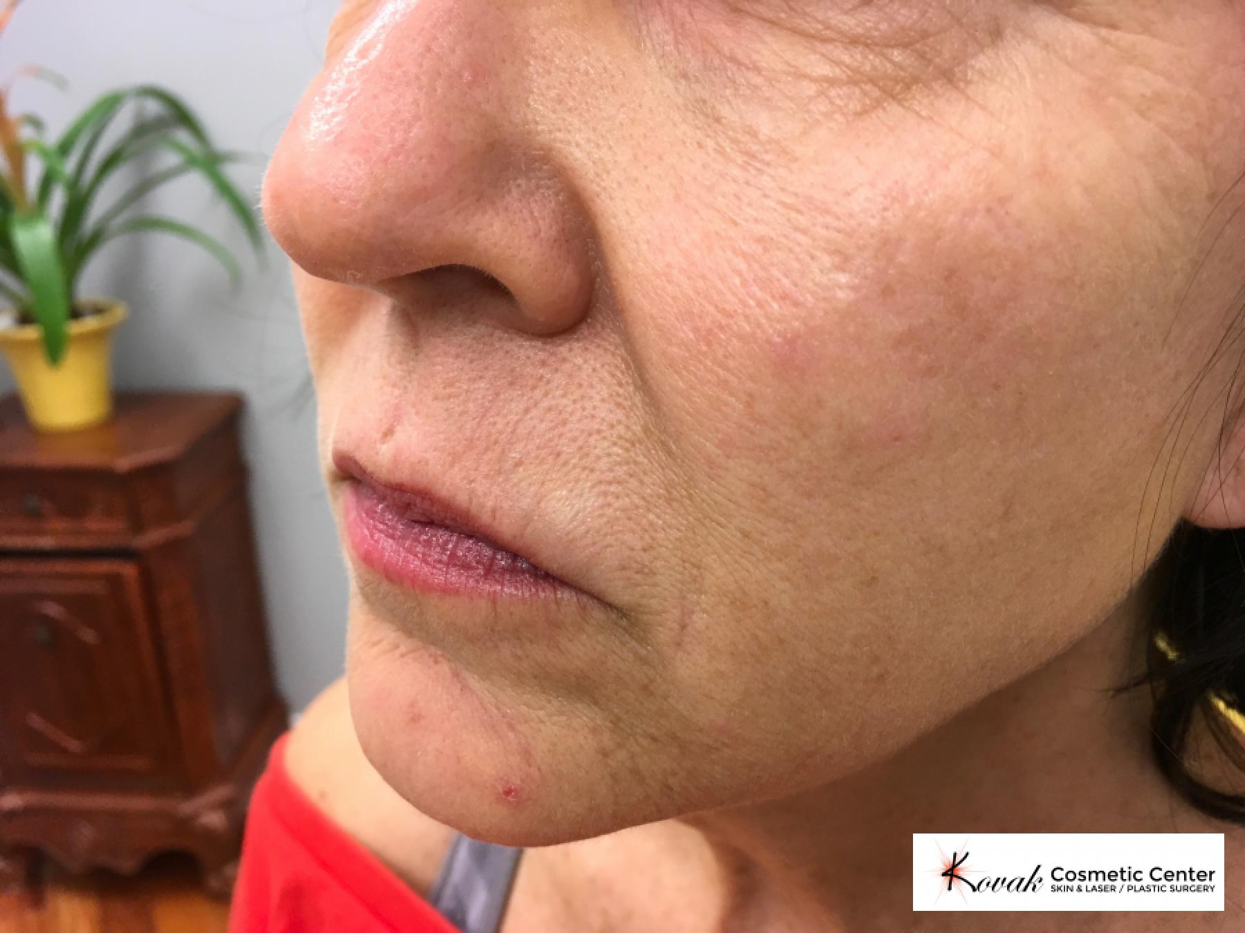 Restylane® Silk: Patient 4 - After 2