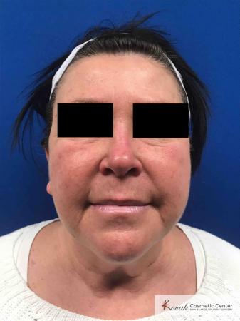 Neck Lift: Patient 2 - Before 1