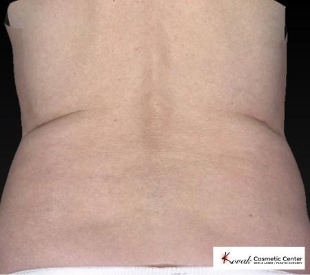 CoolSculpting®: Patient 13 - After 5
