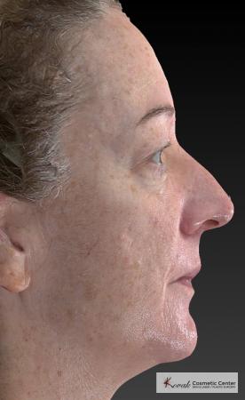 Tyte And Bryte – Face: Patient 6 - Before Image 4