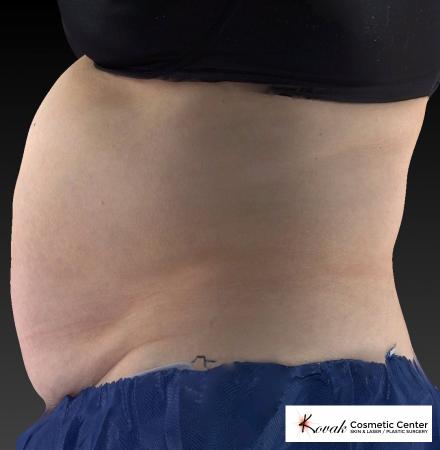 CoolSculpting®: Patient 8 - Before 3