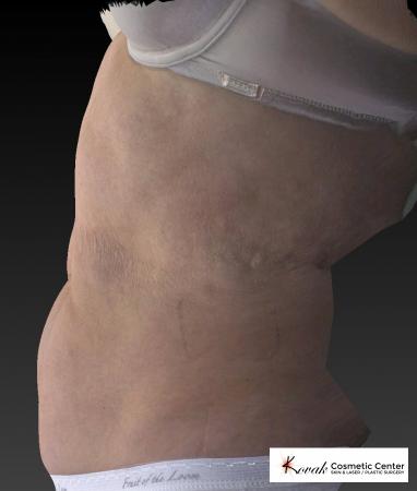CoolSculpting®: Patient 13 - After 2