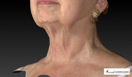 Kybella: Patient 3 - After Image 4