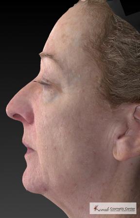 Tyte And Bryte – Face: Patient 6 - After Image 3