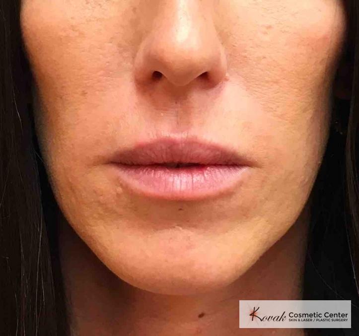 Injectables: Patient 7 - Before 