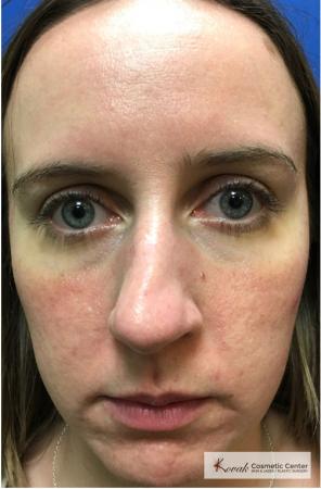 Venus Viva: Patient 1 - After Image 1
