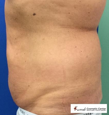 CoolSculpting®: Patient 1 - After 3