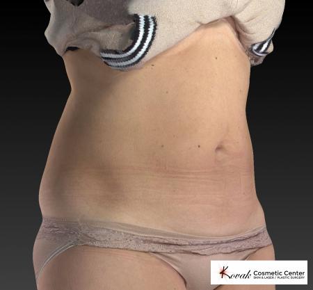 CoolSculpting®: Patient 10 - After 2