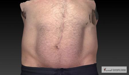 CoolSculpting®: Patient 20 - Before 3