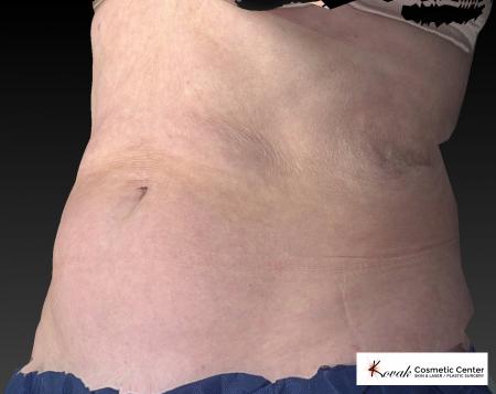 CoolSculpting®: Patient 13 - Before 1
