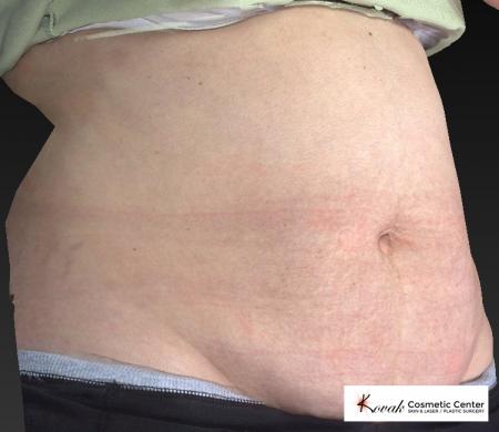 CoolSculpting Patient 101 - Before 2