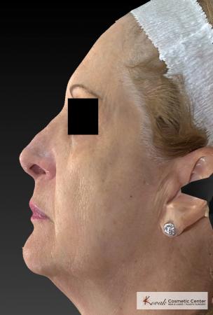 Sculptra®: Patient 5 - Before 2