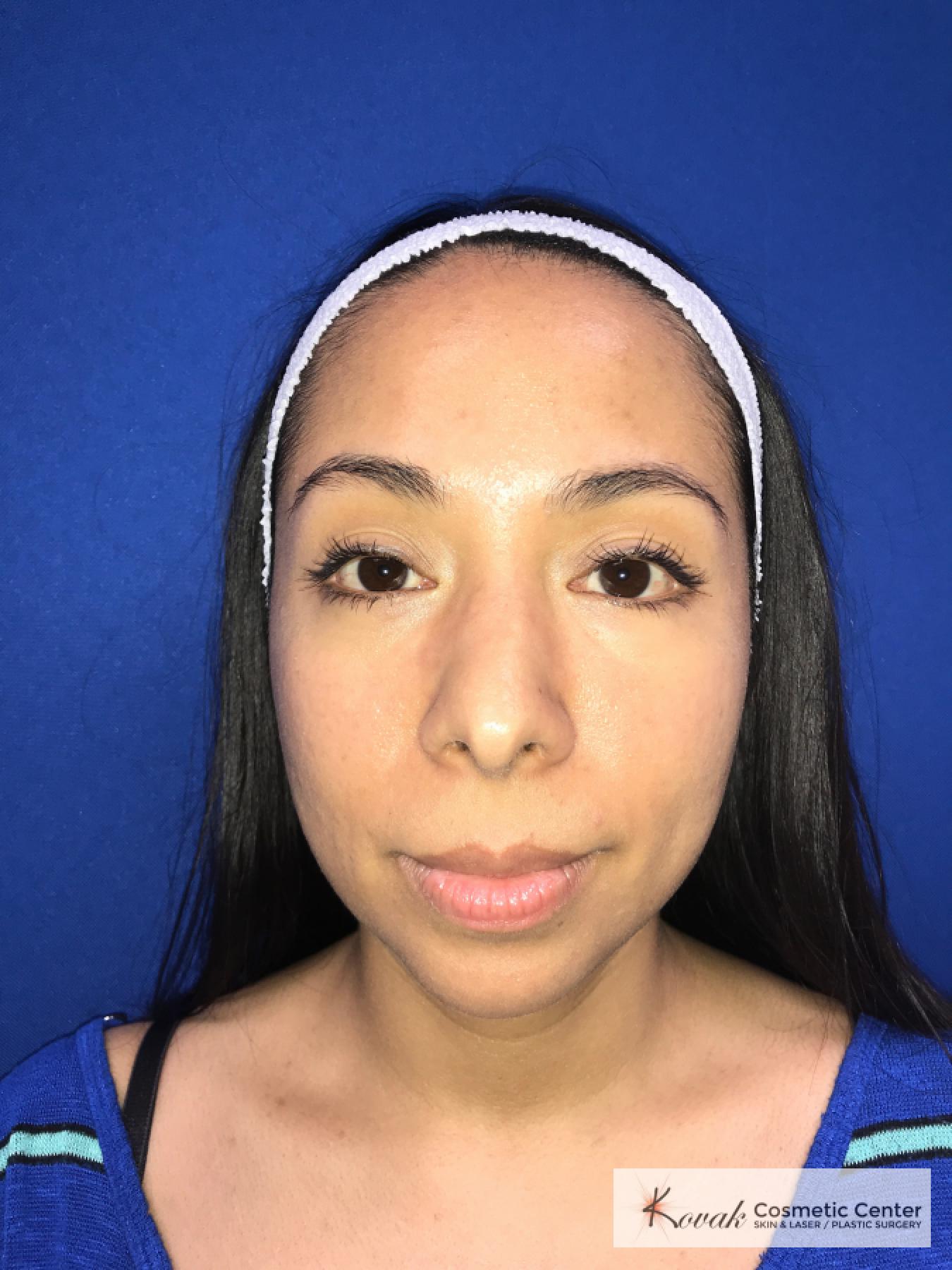 Restylane®: Patient 3 - Before 