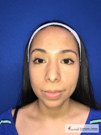 Restylane®: Patient 3 - Before Image 1