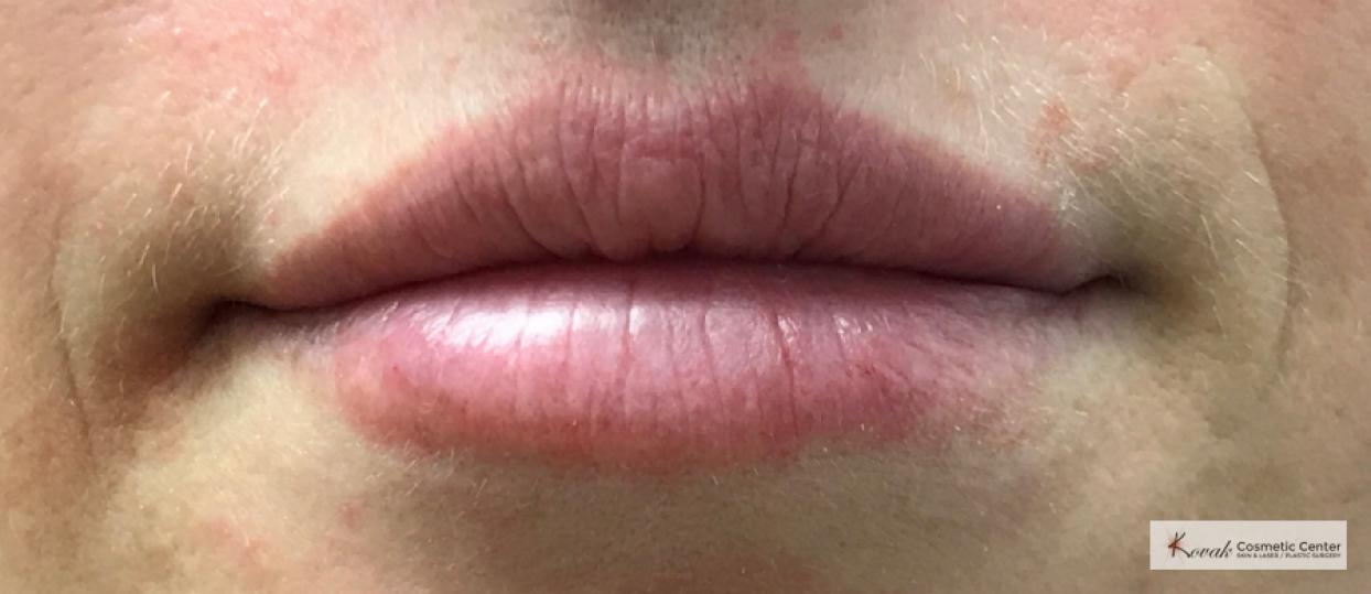 Restylane®: Patient 2 - After 3