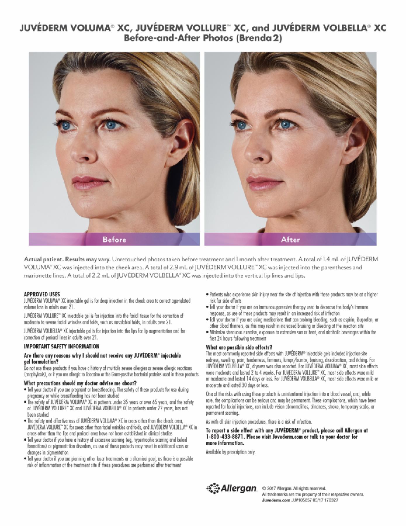 Before and After Gallery for Jevederm XC Dermafillers - After