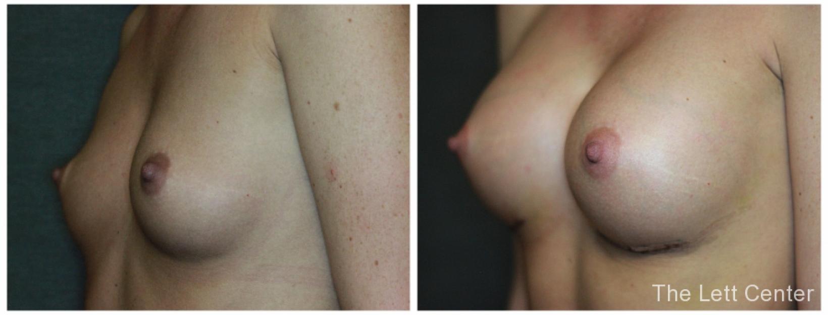 dr lett lebanon and mt juliet B&A - 1 mo post breast augmentation - Before and After 2