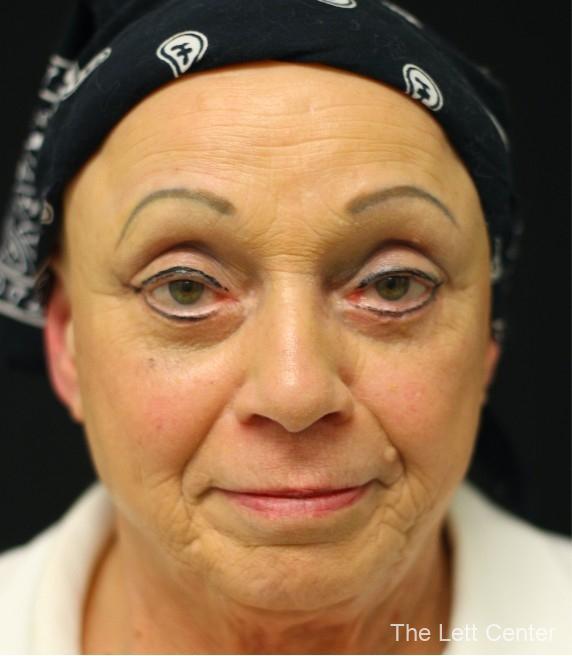 FaceTite with Lower Blepharoplasty -  After 1