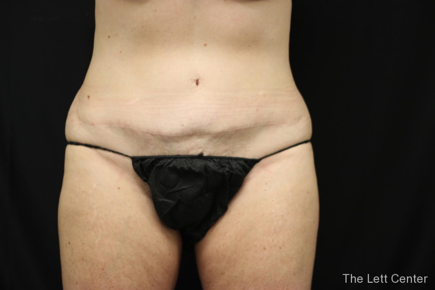 before and after results from BodyTite body sculpting - Before