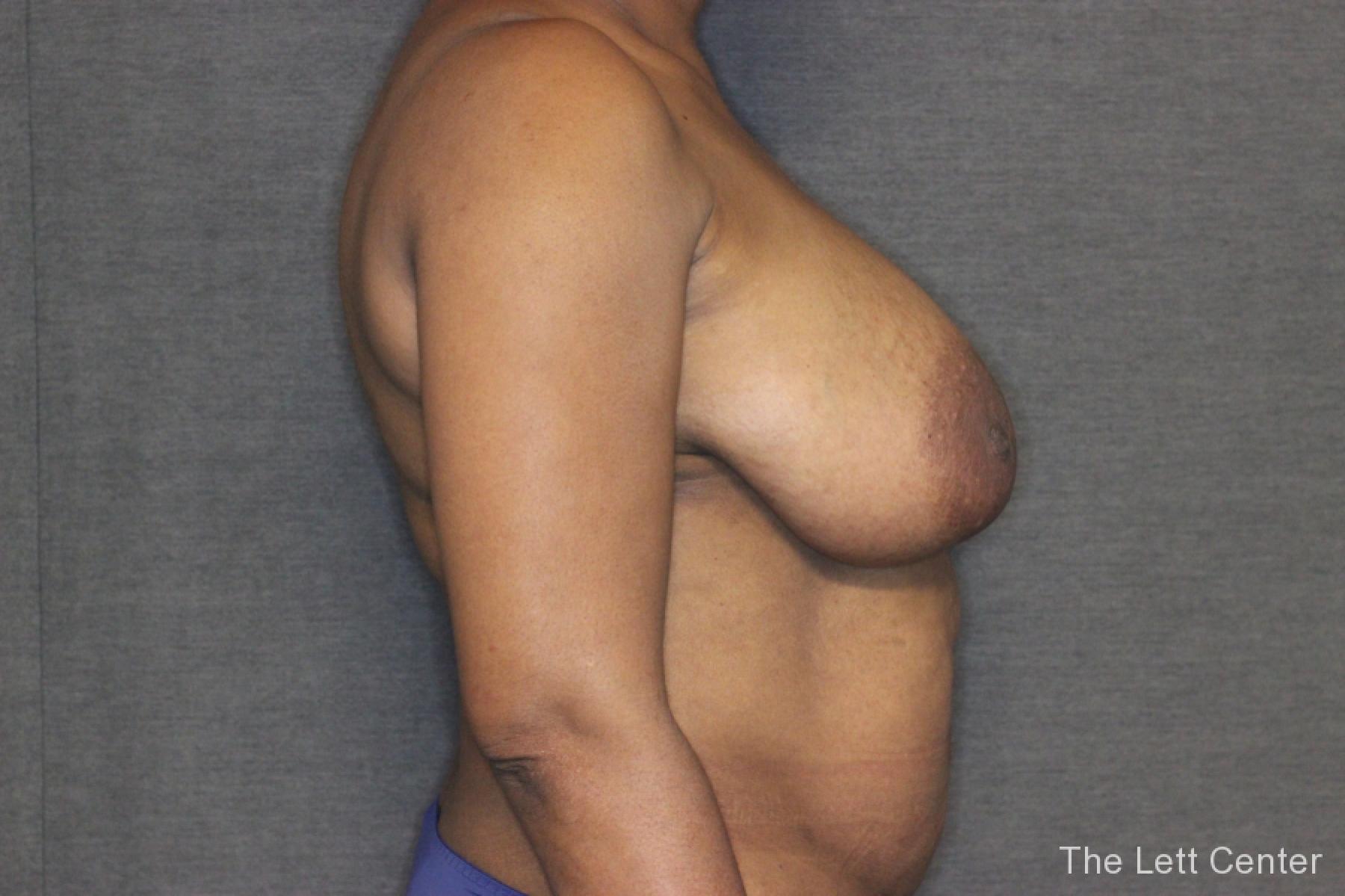 Patient 2 Results from Breast Reduction Surgery at The Lett Center - Before 3
