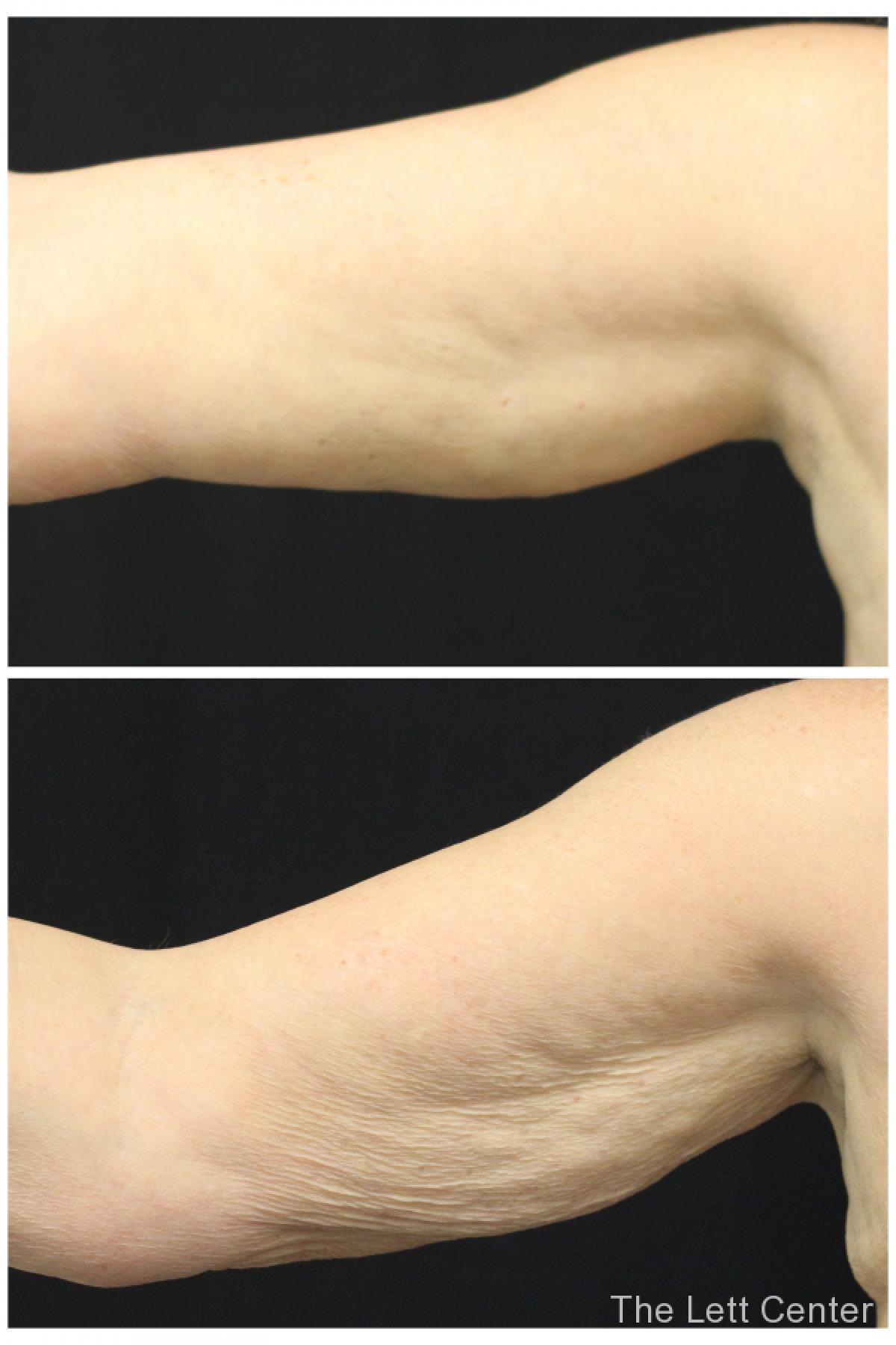 body contouring upper arm brachioplasty the lett center - Before and After