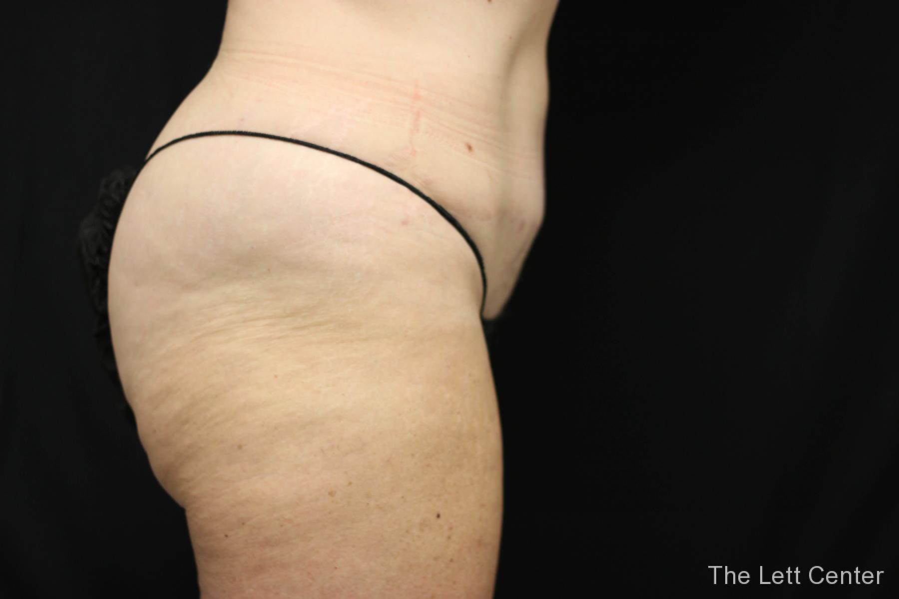 before and after results from BodyTite body sculpting - After 3